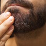 Comment éliminer les pellicules de barbe ?