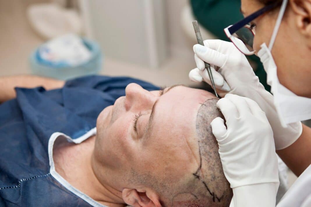 Les avantages de réaliser une greffe de cheveux DHI 